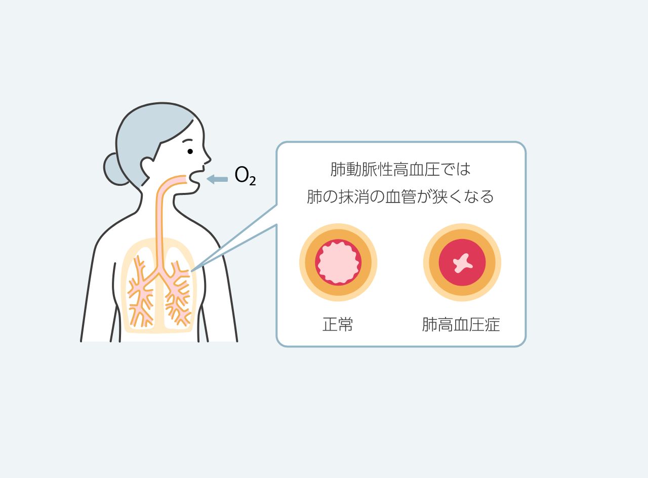 心原性ショック